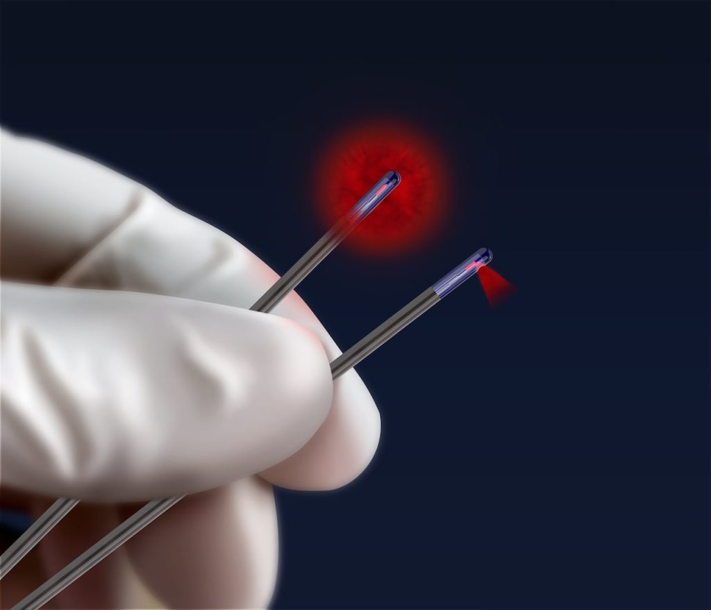 Pilonidal cyst laser